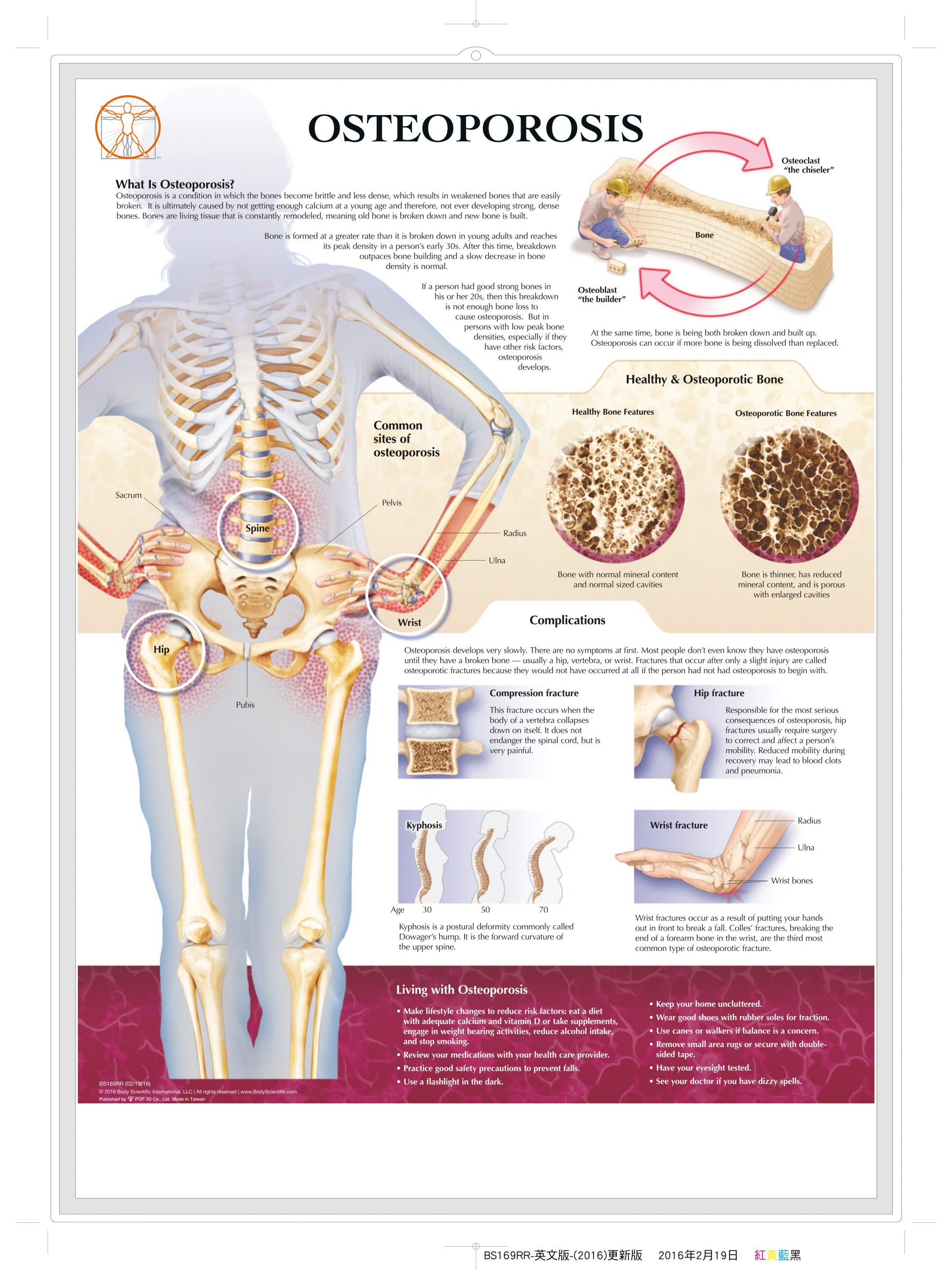 BS169RR-Osteoporosis(1)